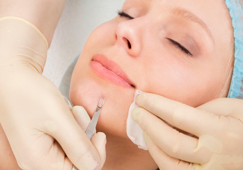 Gloved hands pressing cotton pads around a woman's chin during a facial extraction