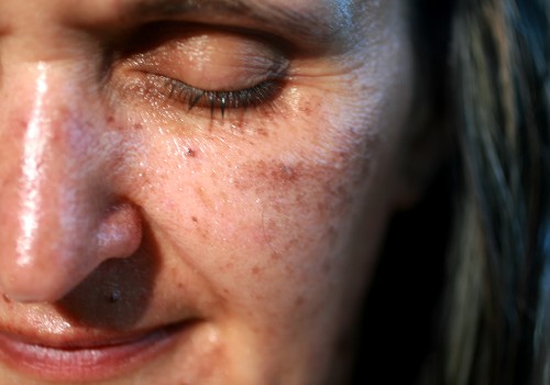 Close-up of freckles and darker patches on a woman's cheek beneath her closed eye