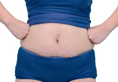 Woman in a blue top and shorts showing stretch marks across her lower abdomen