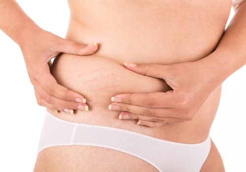 Woman framing the stretch marks on her lower abdomen with both hands