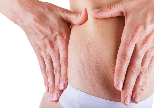 Close-up of stretch marks near a woman's hip with her hands resting on either side