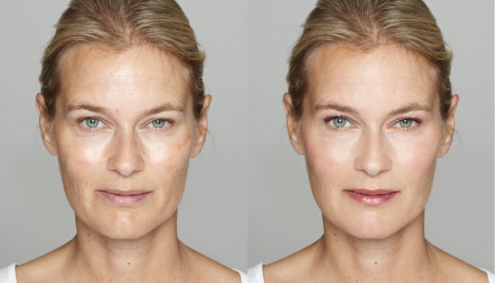 Side-by-side facial portraits showing uneven pigmentation on the left and a more even-looking complexion on the right