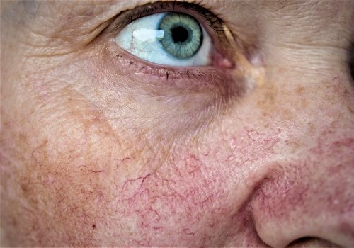 Close-up of a cheek beneath the eye showing redness and small visible blood vessels