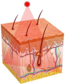 Illustration of a red light beam aimed at a skin cross-section showing hair follicles and blood vessels