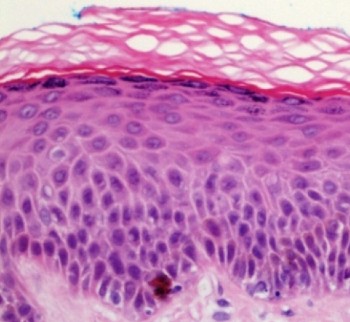 Microscope view of a stained skin cross-section presented as the article's after-treatment image