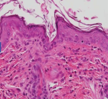 Microscope view of a stained skin cross-section presented as the article's before-treatment image