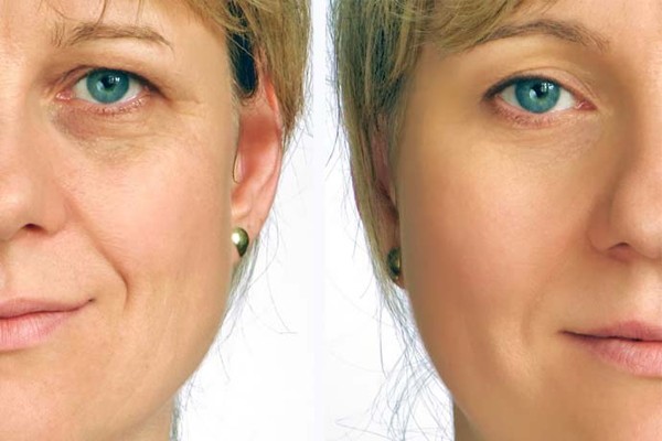 Side-by-side close-ups of a woman's eye area, with under-eye lines appearing less pronounced on the right