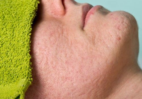 Close-up of a reclining woman's cheek and chin showing redness and uneven skin texture