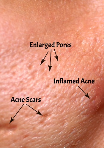 Close-up of facial skin with arrows labeling enlarged pores, inflamed acne, and acne scars