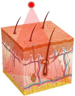 Infrared light therapy