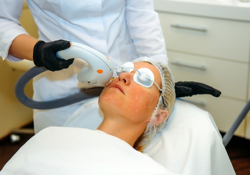 Laser treatment for rosacea