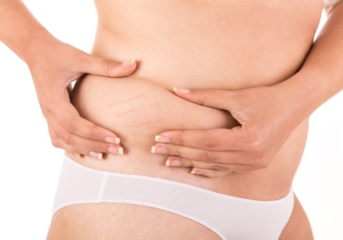 How to Get Rid of White Stretch Marks
