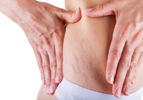 A woman with white stretch marks